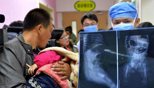 TQ: D&amp;igrave; ruột đ&amp;acirc;m 12 kim ti&amp;ecirc;m v&amp;agrave;o ch&amp;aacute;u g&amp;aacute;i 11 th&amp;aacute;ng tuổi - 1