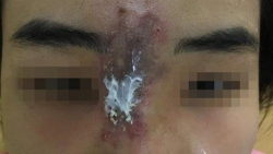 tphcm nu sinh bi hoai tu mui do tiem filler nang mui