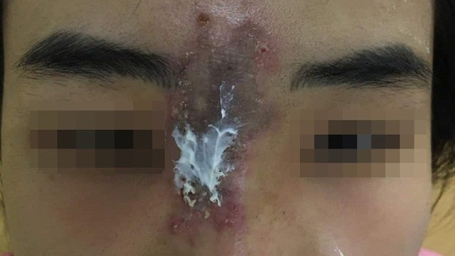 TP.HCM: Nữ sinh bị hoại tử mũi do ti&ecirc;m Filler n&acirc;ng mũi