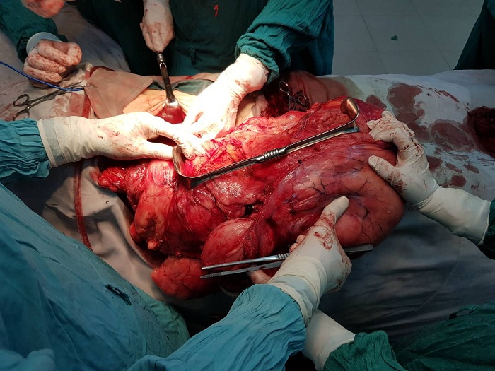 Phẫu thuật lấy khối u nặng 14kg ra khỏi ổ bụng bệnh nhân