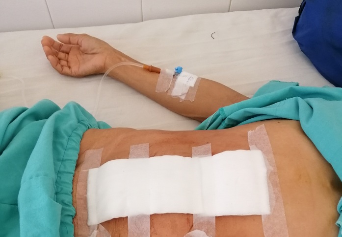 Phẫu thuật lấy khối u nặng 14kg ra khỏi ổ bụng bệnh nhân