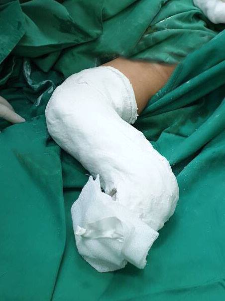 Quảng Nam: Phẫu thuật thành công chân cong thành thẳng cho bé 16 tháng tuổi