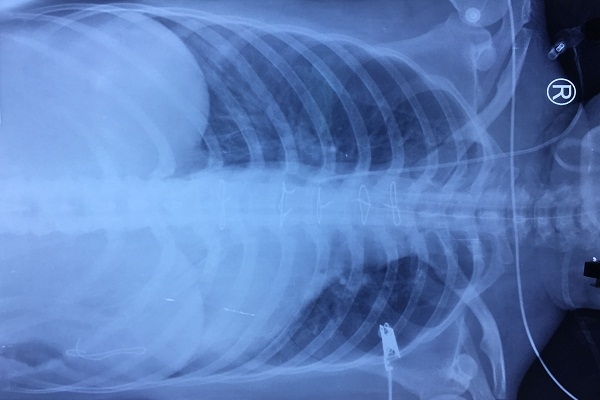 Cứu sống bệnh nhân bị cướp đâm thủng tim và gan